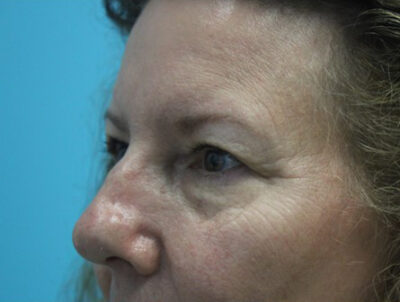 Blepharoplasty