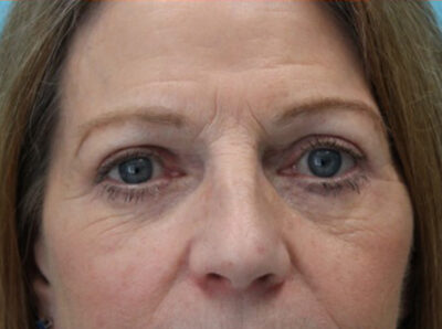 Blepharoplasty