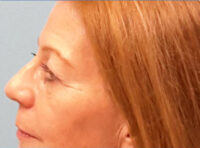 Blepharoplasty