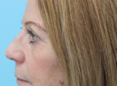 Blepharoplasty