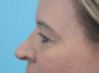 Blepharoplasty