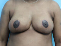 Breast Reduction