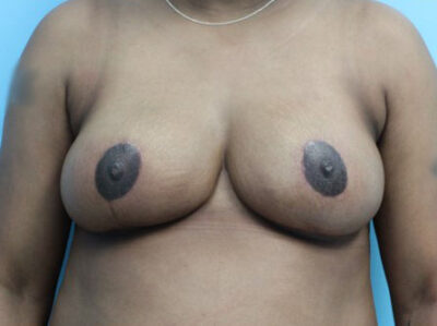 Breast Reduction