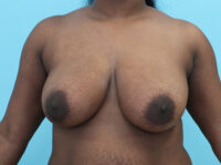 Breast Reduction