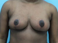 Breast Reduction