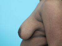 Breast Reduction