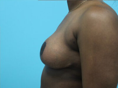 Breast Reduction