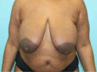 Breast Reduction