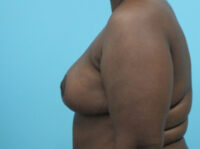 Breast Reduction