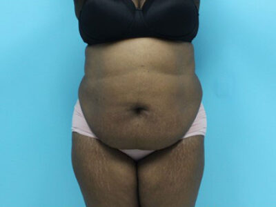 Abdominoplasty