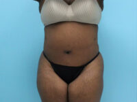 Abdominoplasty