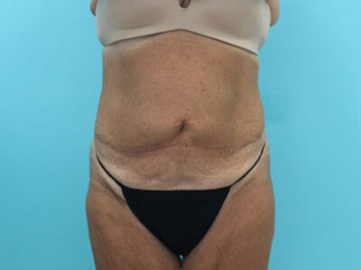 Abdominoplasty