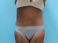 Abdominoplasty