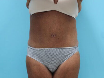 Abdominoplasty