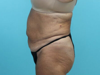 Abdominoplasty