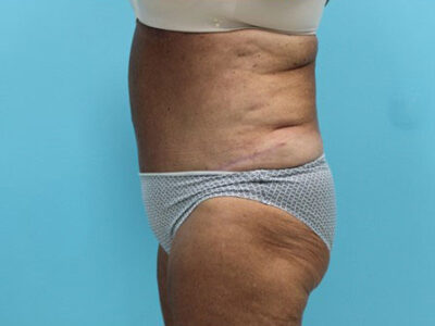 Abdominoplasty