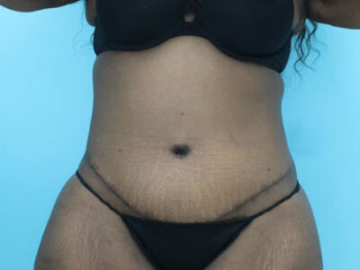 Abdominoplasty