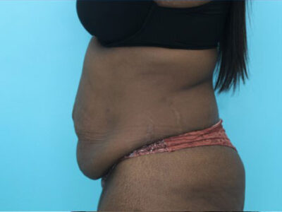 Abdominoplasty