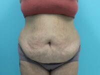 Abdominoplasty