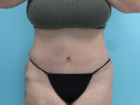 Abdominoplasty