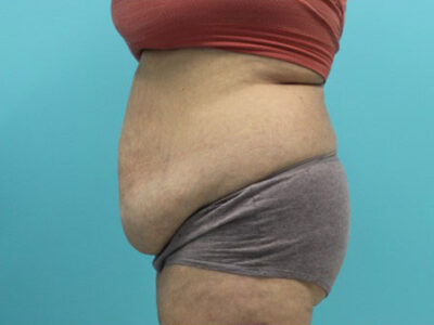 Abdominoplasty