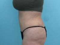 Abdominoplasty