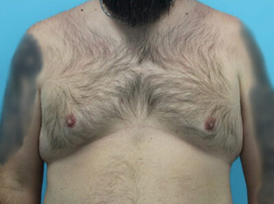 Gynecomastia