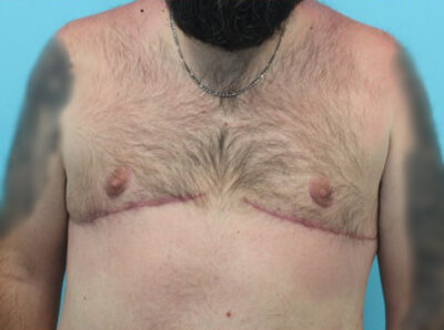 Gynecomastia