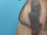 Gynecomastia