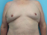 Gynecomastia