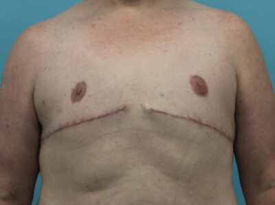 Gynecomastia