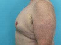 Gynecomastia