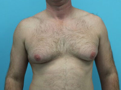 Gynecomastia