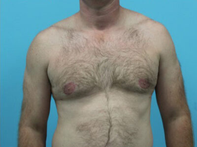 Gynecomastia