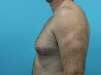 Gynecomastia