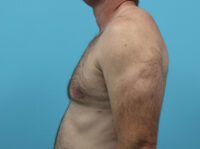 Gynecomastia