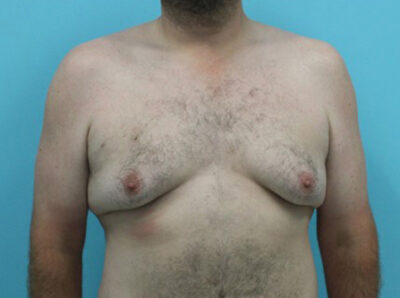 Gynecomastia