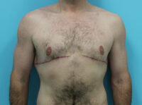 Gynecomastia