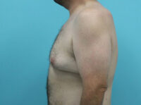 Gynecomastia