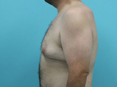 Gynecomastia