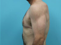 Gynecomastia