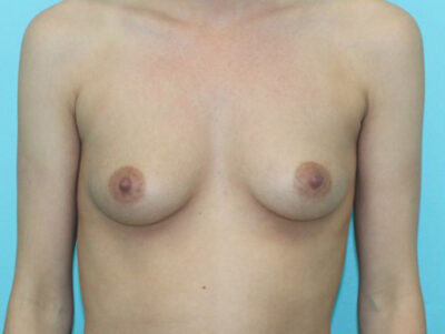 Breast Augmentation