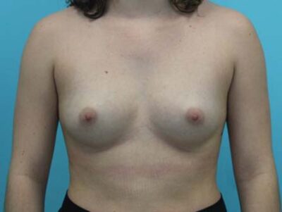 Breast Augmentation