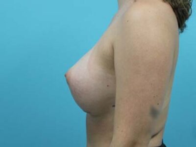 Breast Augmentation