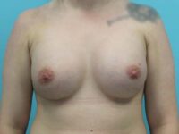 Breast Augmentation