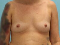 Breast Augmentation