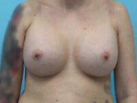 Breast Augmentation