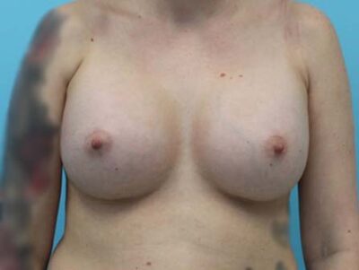 Breast Augmentation