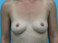 Breast Augmentation