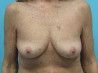 Breast Augmentation